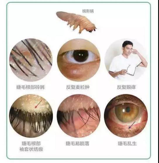 没有沙子的眼睛里,却可能寄居着无数可怕的螨虫